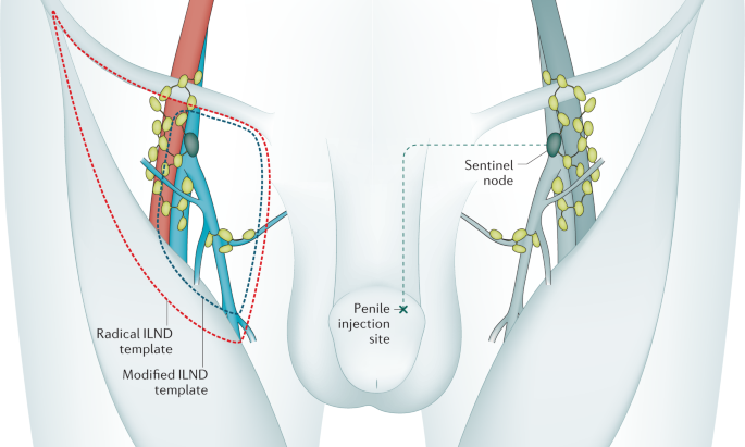 PENILE CANCER