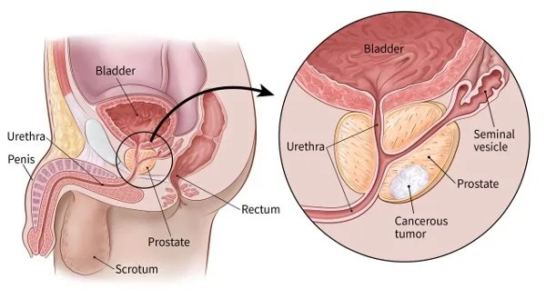 PROSTATE CANCER