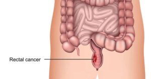 RECTAL CANCER