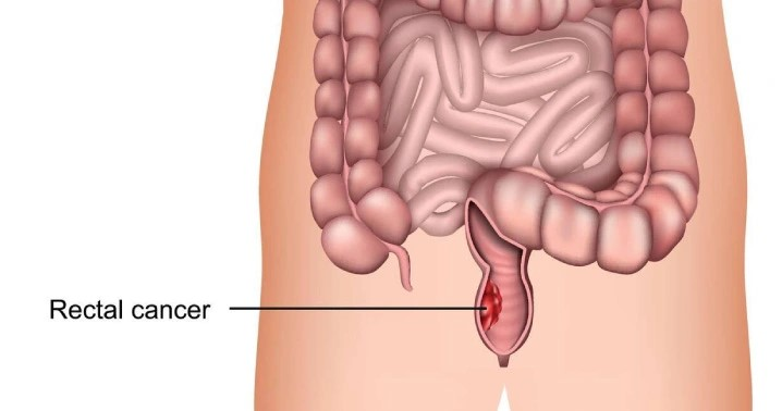 RECTAL CANCER