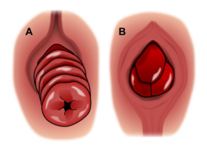 RECTAL PROLAPSE