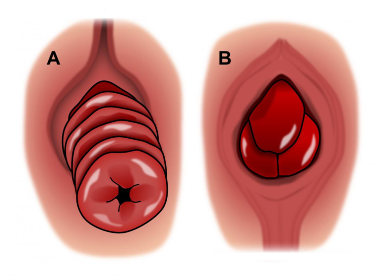 RECTAL PROLAPSE