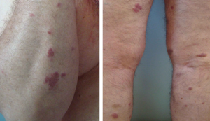 SARCOMA