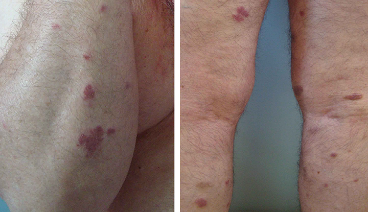 SARCOMA