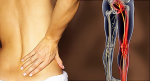 SCIATICA