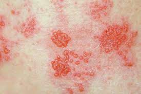 SHINGLES
