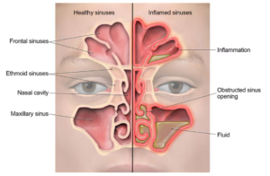 SINUS INFECTION