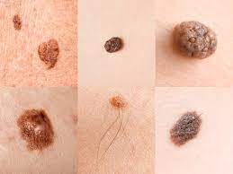 SKIN CANCER