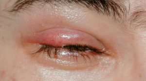 STYE