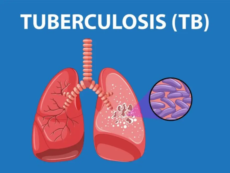 TUBERCULOSIS