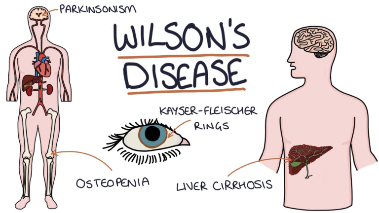 WILSON'S DISEASE