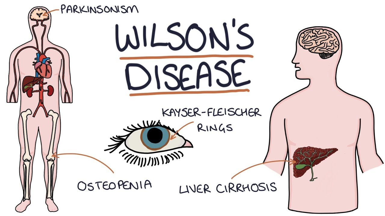 WILSON'S DISEASE