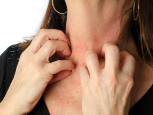 ANAPHYLAXIS