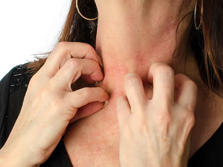 ANAPHYLAXIS