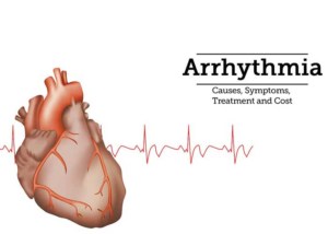ARRHYTHMIA