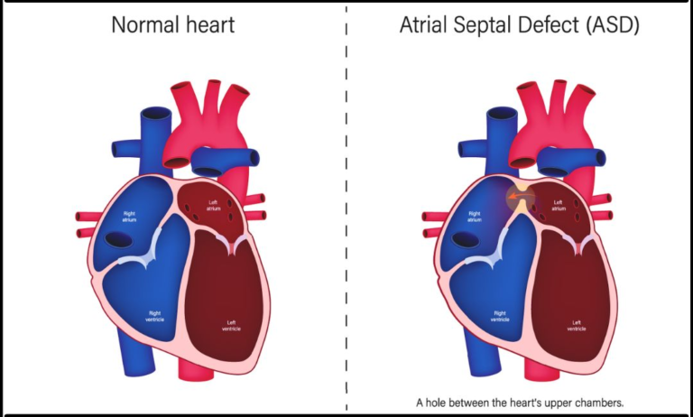 ATRIAL SEPTAL DEFECT (ASD)