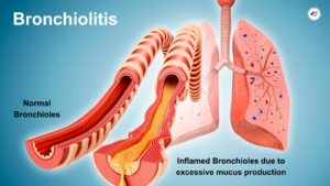 BRONCHIOLITIS
