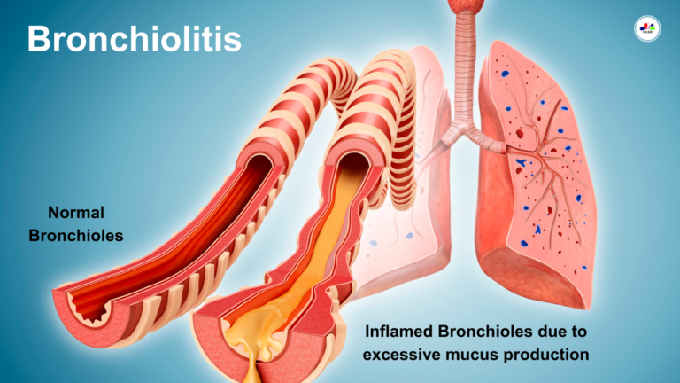 BRONCHIOLITIS