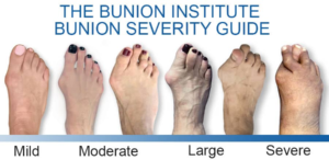BUNIONS
