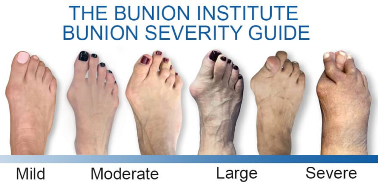 BUNIONS