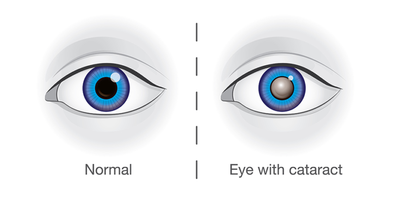 CATARACTS