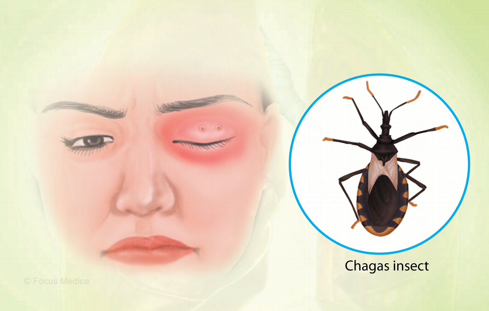 CHAGAS DISEASE