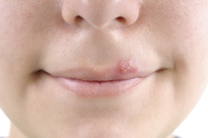 Cold Sores