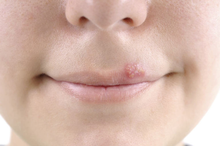 Cold Sores