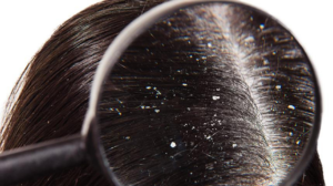 DANDRUFF