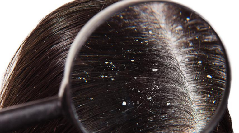 DANDRUFF