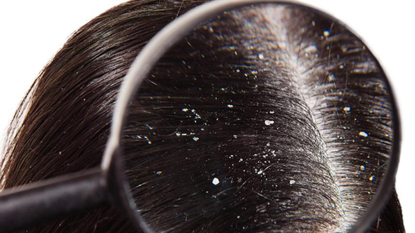 DANDRUFF