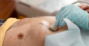 DESMOID TUMORS