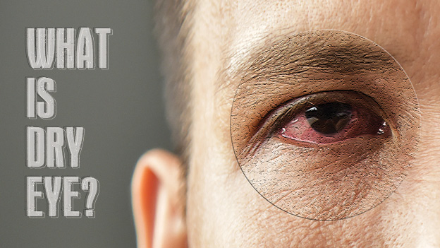 DRY EYE DISEASE