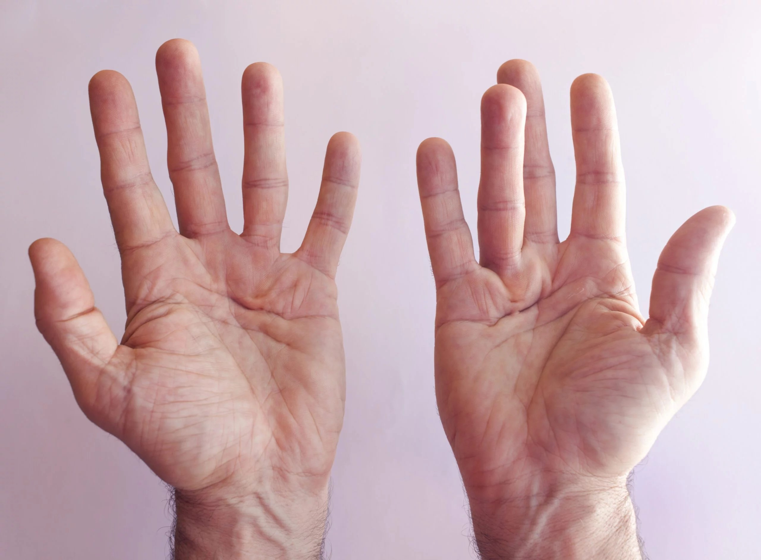 DUPUYTREN'S CONTRACTURE