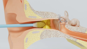 EARWAX BLOCKAGE
