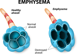 EMPHYSEMA
