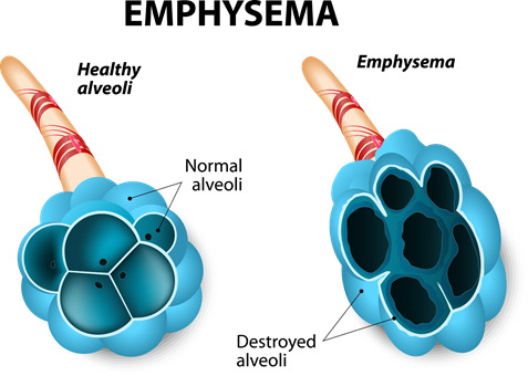 EMPHYSEMA