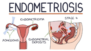 ENDOMETRIOSIS