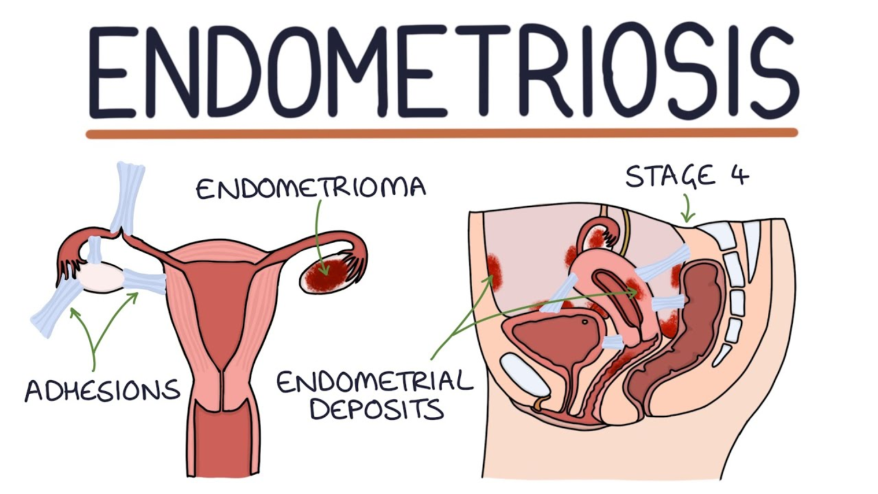 ENDOMETRIOSIS