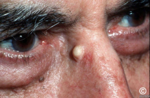 EPIDERMOID CYSTS