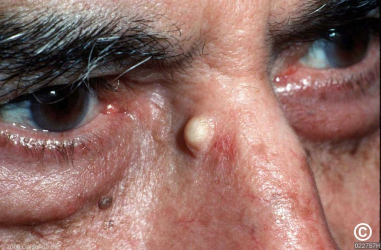 EPIDERMOID CYSTS