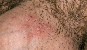 GENITAL HERPES
