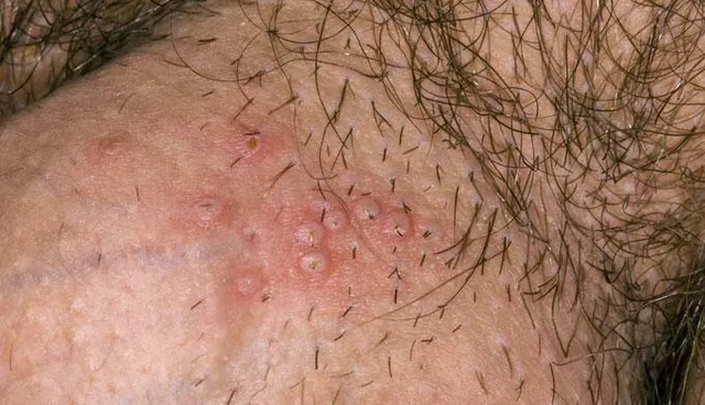 GENITAL HERPES