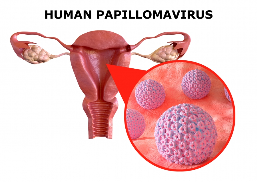 HPV (HUMAN PAPILLOMAVIRUS) INFECTION