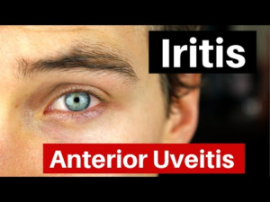 IRITIS