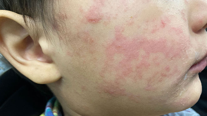 MEASLES