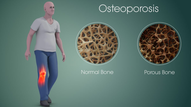OSTEOPOROSIS