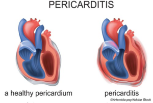 PERICARDITIS