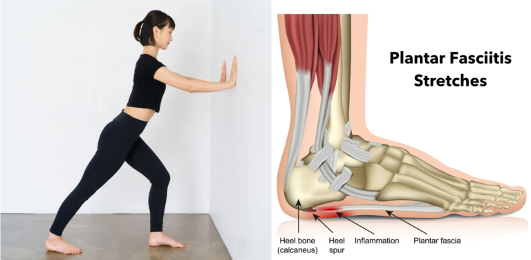 PLANTAR FASCIITIS