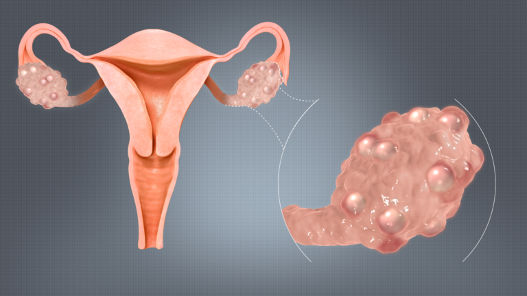 POLYSYSTIC OVARY SYNDROME